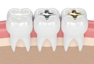 illustration of three teeth, each with a different type of dental filling, Narberth, PA general dentistry