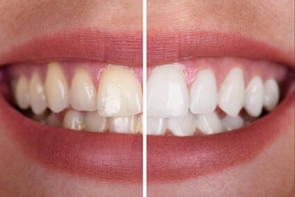 split image of woman's teeth showing before and after results of professional teeth whitening Narberth, PA cosmetic dentistry