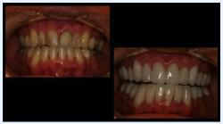Before and After Dental Treatment | Buford, GA Dentist