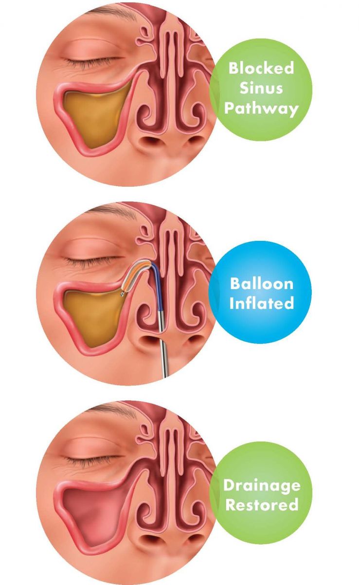 Balloon Sinus Dilation