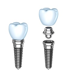 Dental Implants Milford MI | Dentist