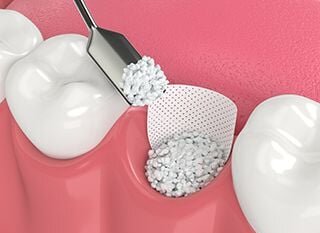 illustration of bone graft material being added in empty tooth socket, dentist Melrose, MA bone grafting for dental implants