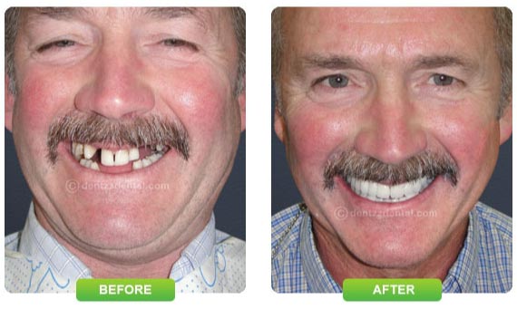 older man with mustache smiling with missing teeth, after image on right of him smiling with dental implants Melrose, MA dentist