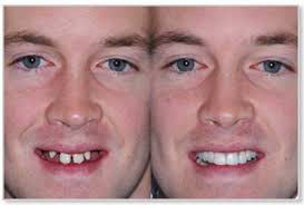 before and after image of man smiling missing teeth, then man smiling after tooth replacement dental implants dentist Melrose, MA