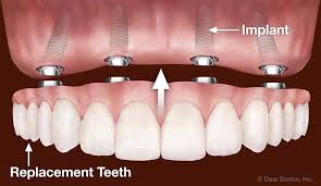 illustration showing All on 4 Implant supported dentures Melrose, MA cosmetic dentistry