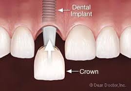 illustration of crown being placed over Dental Implant Melrose, MA cosmetic dentistry