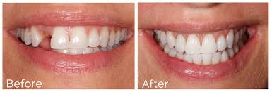 Before and After image of tooth missing in mouth then replaced with Dental Implants Melrose, MA dentist