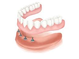 All on 4 Dental Implant dentures Melrose, MA dentist