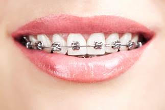 close up of woman's smiling mouth showing braces, Orthodontics Melrose, MA