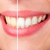 before and after image for professional Zoom Teeth Whitening Melrose, MA