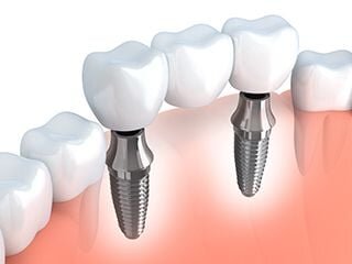 illustration of dental implant bridge being placed in mouth to replace several teeth, dentist Melrose, MA dental implants