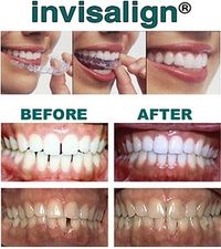 collage of before and after images of teeth straightened with Invisalign Melrose orthodontist