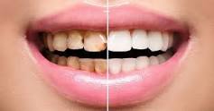 Image result for dental veneers images