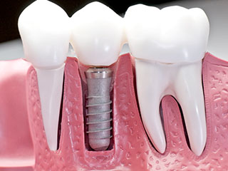 model of plastic teeth and gums showing embedded dental implants North York, ON dentist