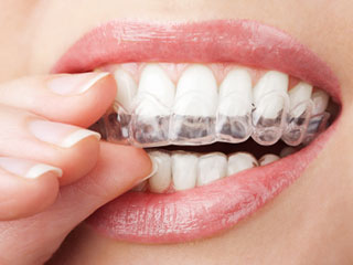 hand holding clear aligners on teeth, Invisalign North York, ON dentist
