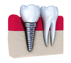 dental implants kalamazoo, MI