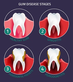 Gum Disease Treatment - Waltham, MA Periodontist