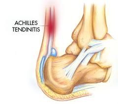 Achilles Tendonitis