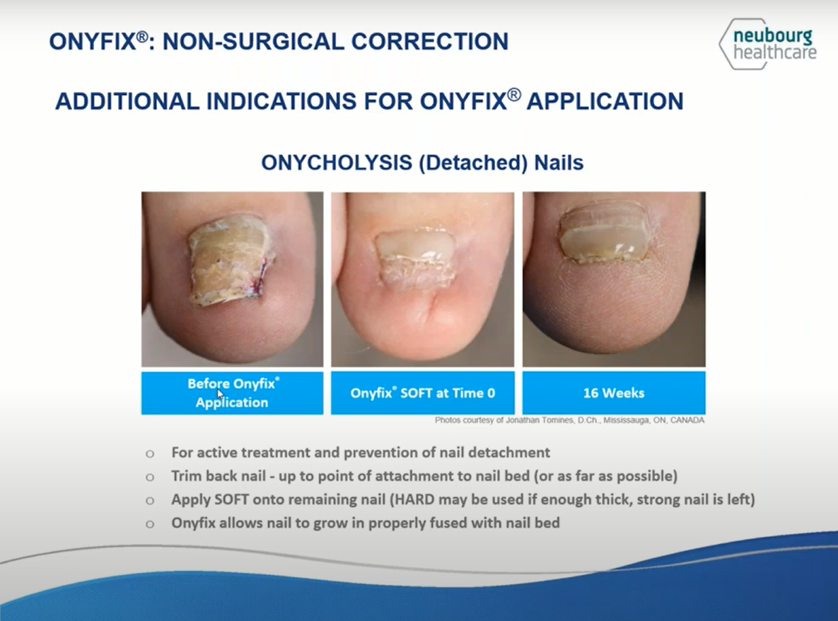 Onyfix can treat detached toenail