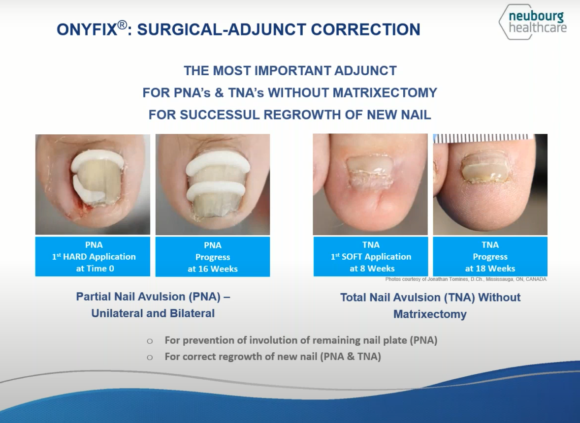Onyfix can be used after partial or total nail avulsion