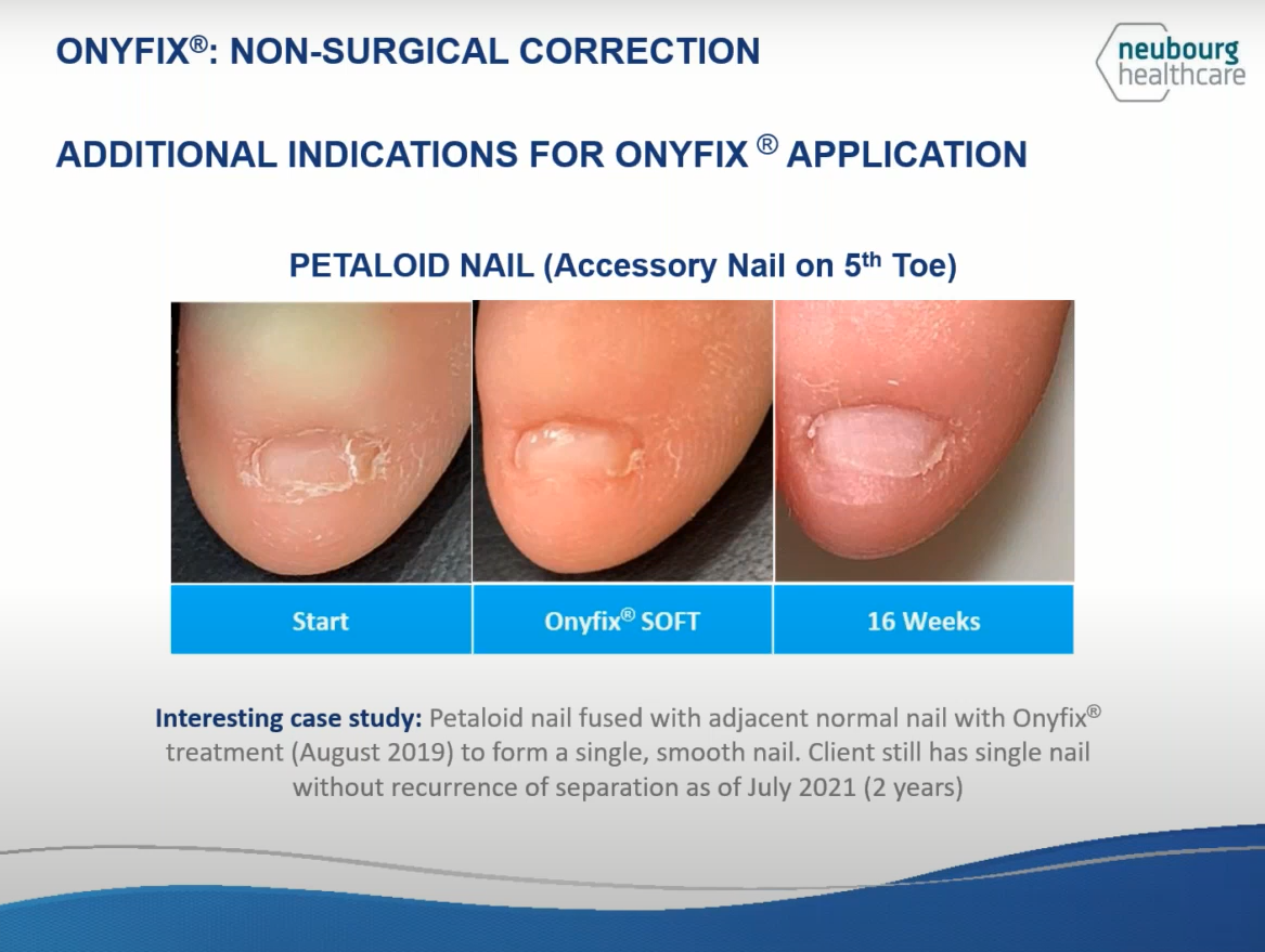 Onyfix can fix petaloid toenails