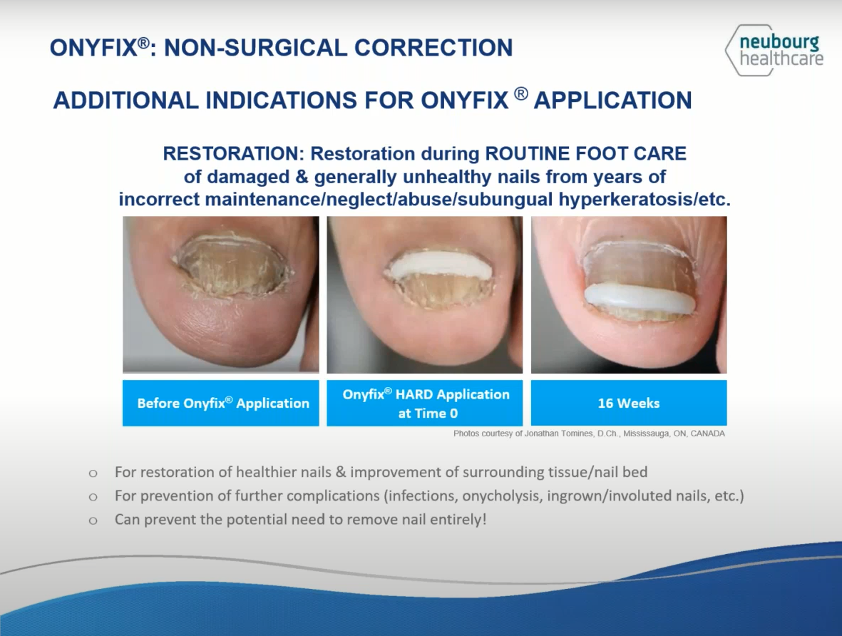Onyfix can be used to restore damaged toenails