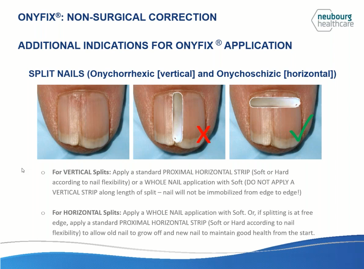 Onyfix can be used for split nails