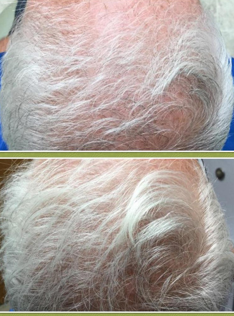 PRP Treatment (for Hair Loss)
