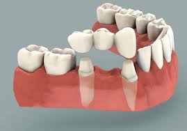Crowns and Bridges | Dentist in Saluda, SC | Saluda Smilemakers