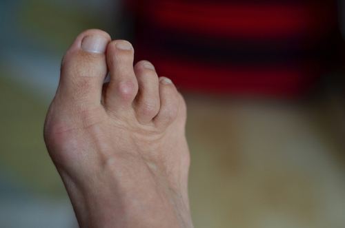 Close-up of a woman's bare feet showing hammer toe deformity.
