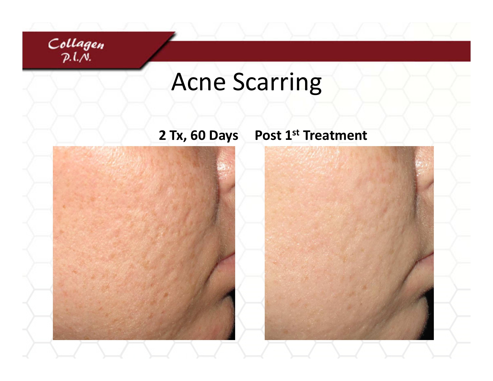 Microneedling Beachwood, Oh Before and After