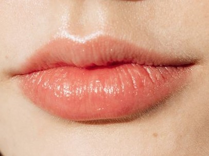 Beautiful Full Lips Lip Filler