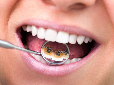 close up of dental mirror in woman's open mouth reflecting back of her teeth with lingual braces Fairfax, VA orthodontic treatment