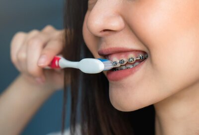 girl brushing teeth around her braces, orthodontics Fairfax, VA best orthodontist