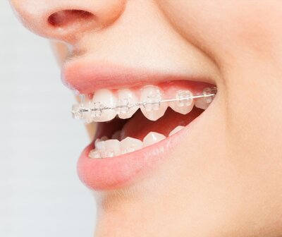 side profile of woman's smiling open mouth, clear braces on teeth, clear braces Fairfax, VA orthodontics
