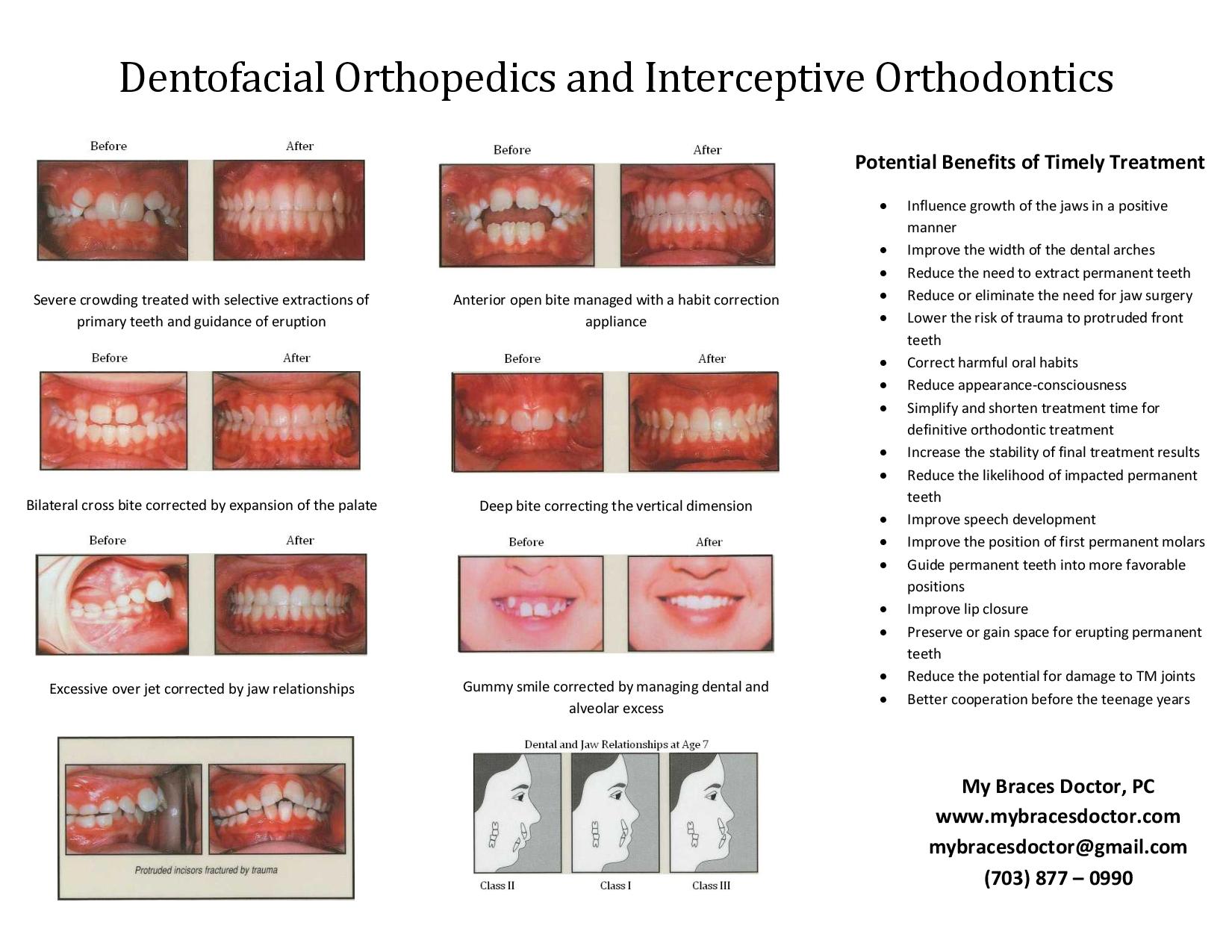 chart with images and text about Dentofacial orthopedics and Interceptive orthodontics Fairfax, VA