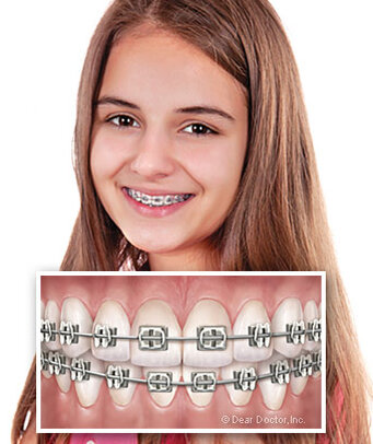girl wearing metal braces, box within image showing close up of teeth with metal brackets and wires, best orthodontist Fairfax, VA