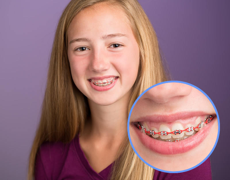 young blond girl wearing braces with pink rubberbands, traditional braces Fairfax, VA orthodontic treatment