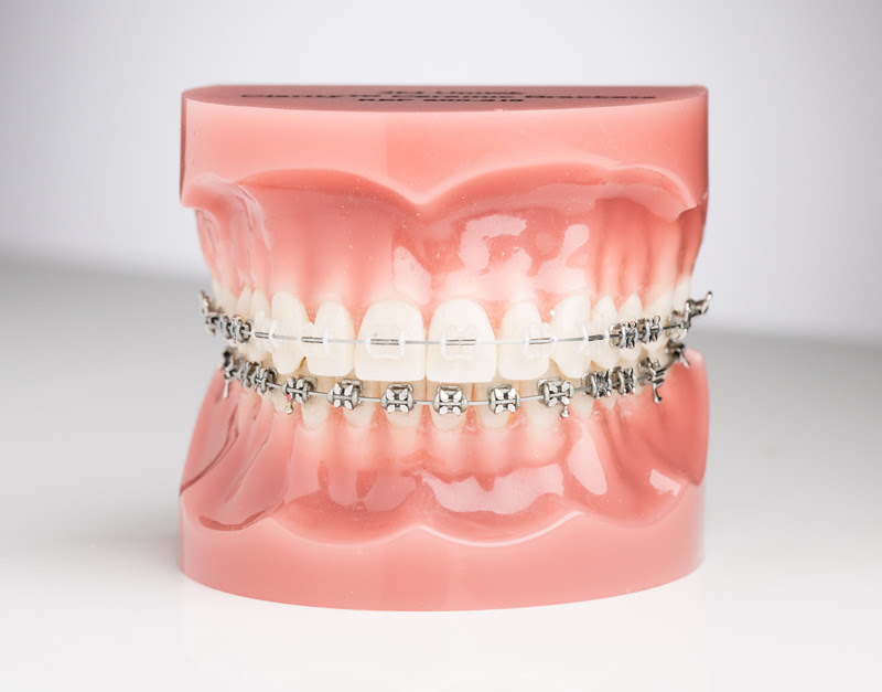 model of teeth with metal braces on lower teeth and ceramic braces on top, best orthodontist in northern VA