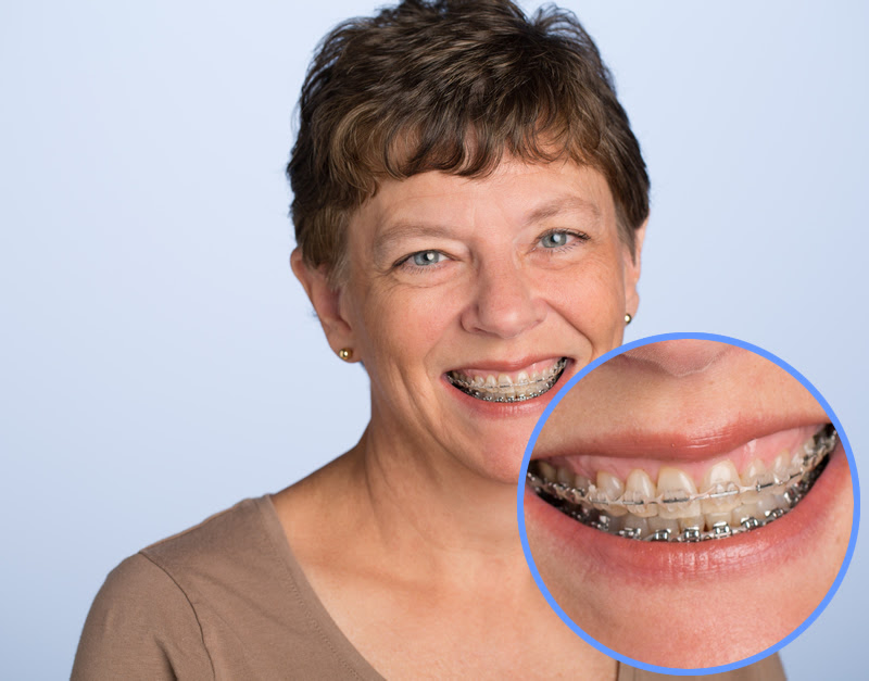 older woman with braces, circle image showing close up of her teeth with ceramic braces on top teeth and metal braces on bottom, orthodontics for adults Fairfax VA