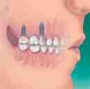 Implants serve as a base for single replacement teeth.
