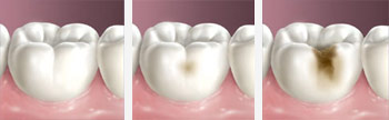 Tooth Cavaties