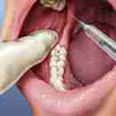 The area around the tooth is numbed before extraction.