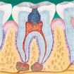 root canal 1
