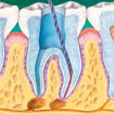 root canal 2