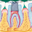 Root canal 3