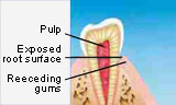 Receding gums expose root surface to heat, cold and pressure.