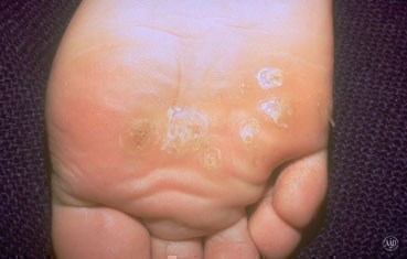 warts-symptoms-foot.jpg