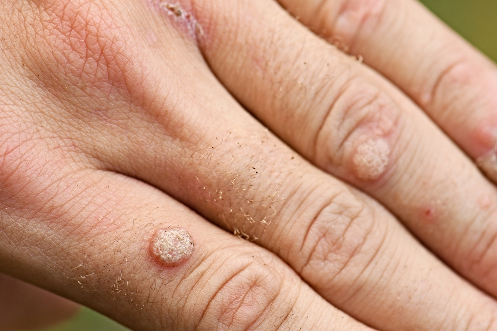 Warts in hand