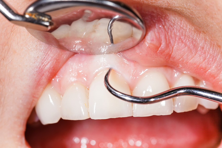 Gum Disease Lynchburg VA | Dentist